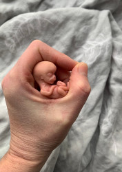 Fetal Fatalities